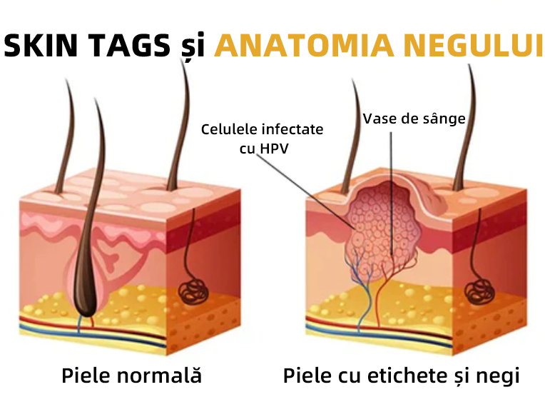 🌈Spray de tratament pentru îndepărtarea negilor și a etichetelor cu venin de albine Cvreoz™(👨‍⚕APDV RECOMANDĂ)🐝🐝(🔥Promoția de ultima zi 80% reducere)