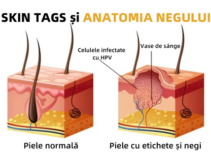 🌈Spray de tratament pentru îndepărtarea negilor și a etichetelor cu venin de albine Cvreoz™(👨‍⚕APDV RECOMANDĂ)🐝🐝(🔥Promoția de ultima zi 80% reducere)